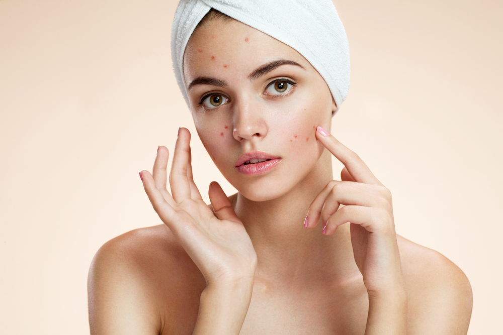 acne natural remedies